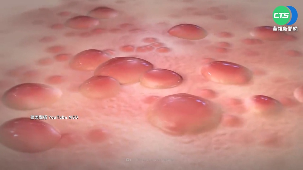 第2例猴痘境外移入! 30多歲男自美國返台