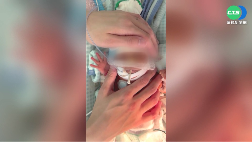 全球最早產! 未滿22周急產女嬰健康成長