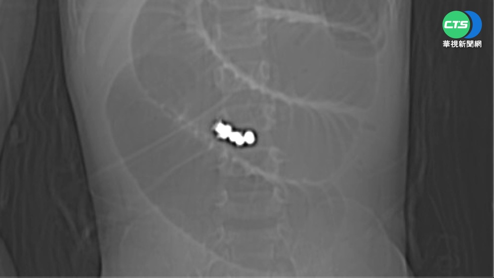 1歲童嘔吐就醫 腸胃驚見8顆巴克球