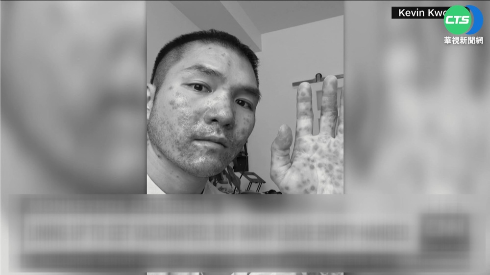 美猴痘逾6600例持續擴散 列"公衛緊急事件"