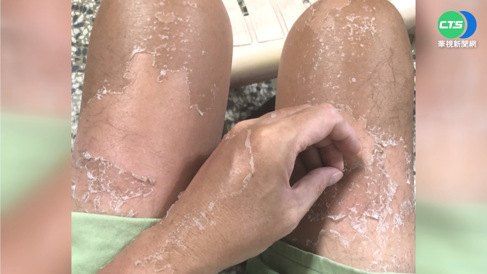 穿短袖短褲騎南橫 男曬傷脫皮成"三層肉"