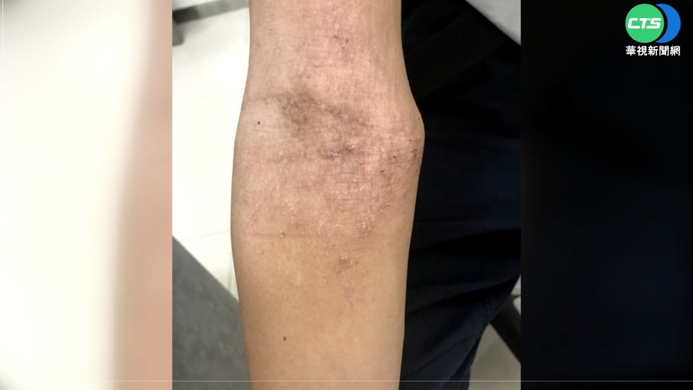 好癢! 高溫炎熱又下雨 隨手抓恐釀皮膚炎