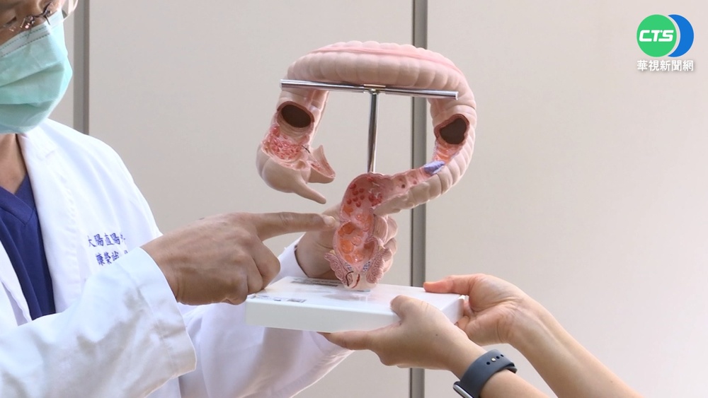 大腸直腸癌年輕化! 7成病患初診已三.四期