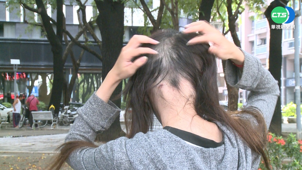 這些體質注意！小心髮際線上移找上門 中醫揭4大主因