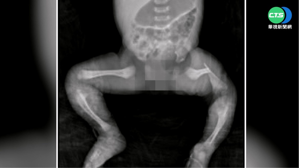 女嬰黃疸住院腿竟骨折 家屬怒提告傷害