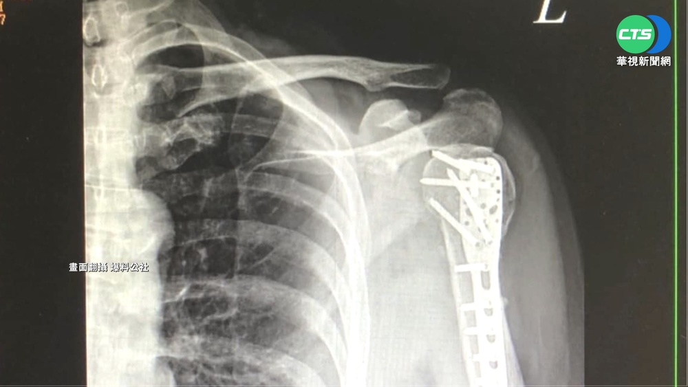 男遭超商空籃絆倒肩骨折 索賠3個月無共識