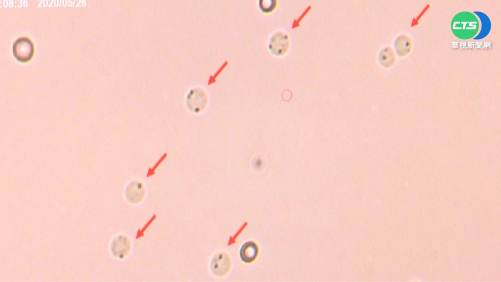 醫學突破! 北榮顯微注射 圓精細胞也能生子
