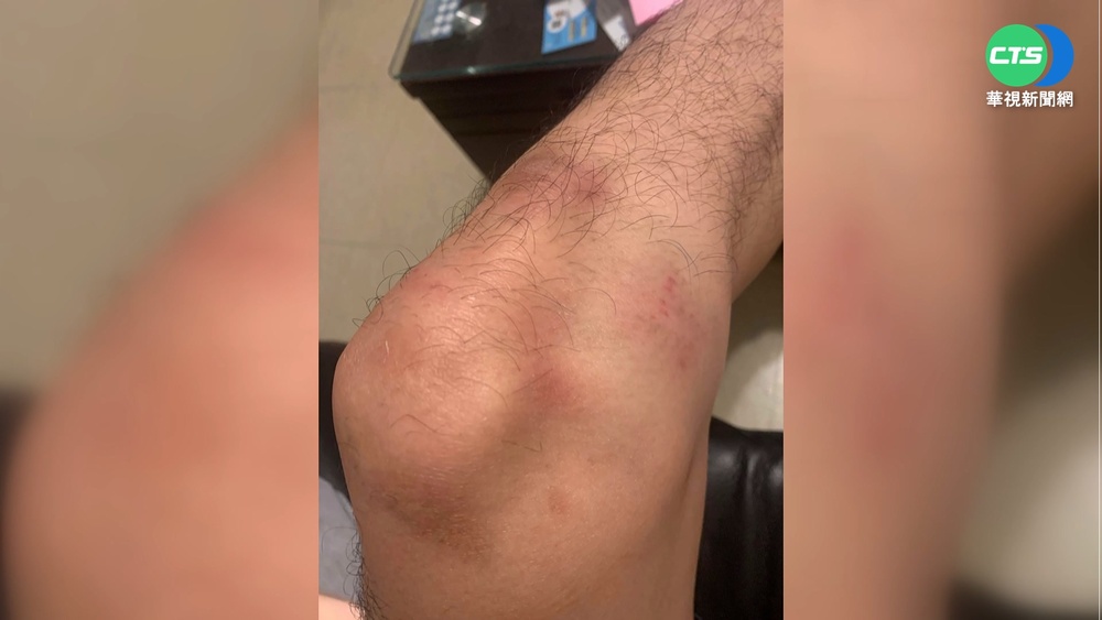 勸架遭壓制! 新北男全身傷控警"執法過當"