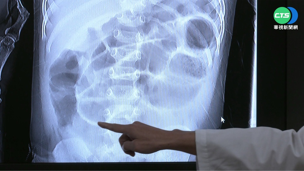1歲女童腹脹送急診 開刀見9cm樹枝卡腸內