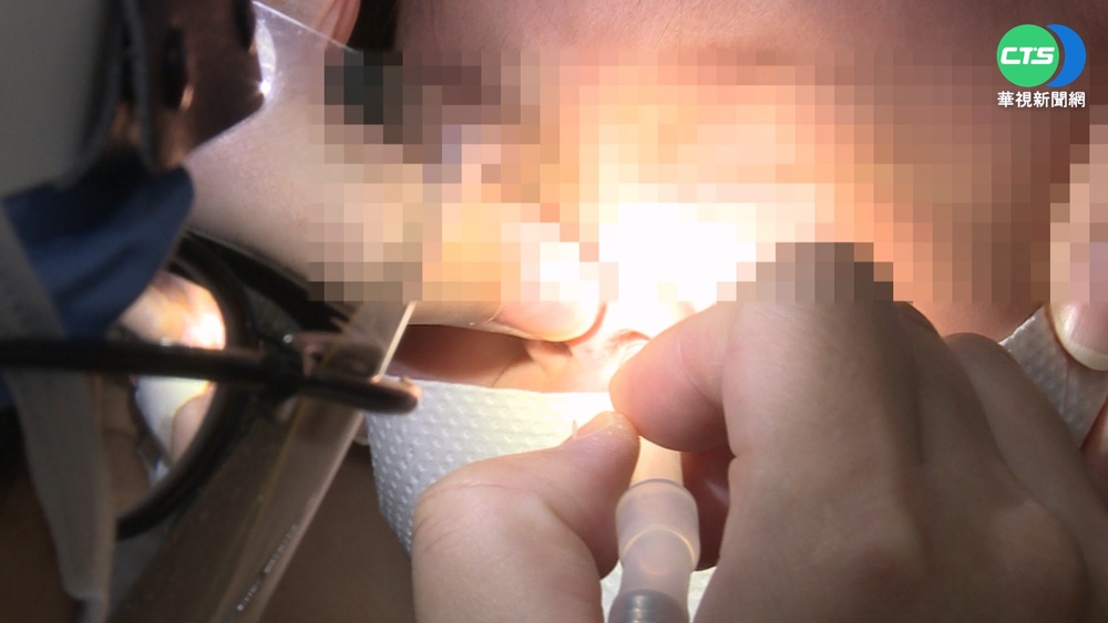 3歲童鼻竇炎近2個月 鼻孔內藏1.5cm貼紙