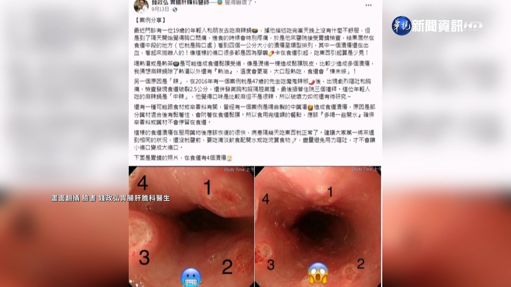 驚!男吃麻辣鍋隔天胸口悶痛 食道竟有4個洞