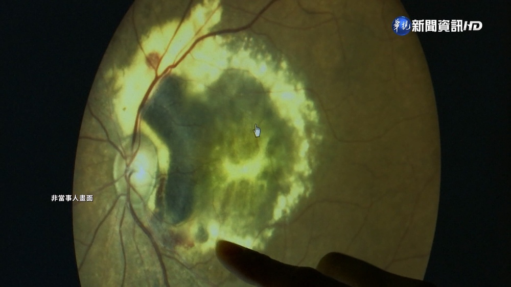 飛蚊症不是老人病! 19歲女腦瘤引發
