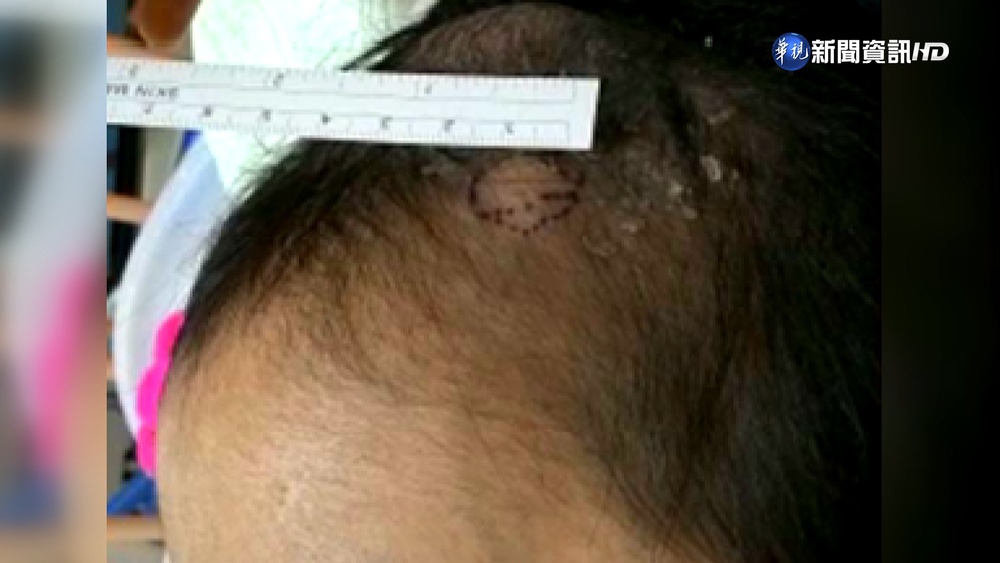 肺炎鏈球菌引發腦膜炎 4歲童額頭"長角"喪命