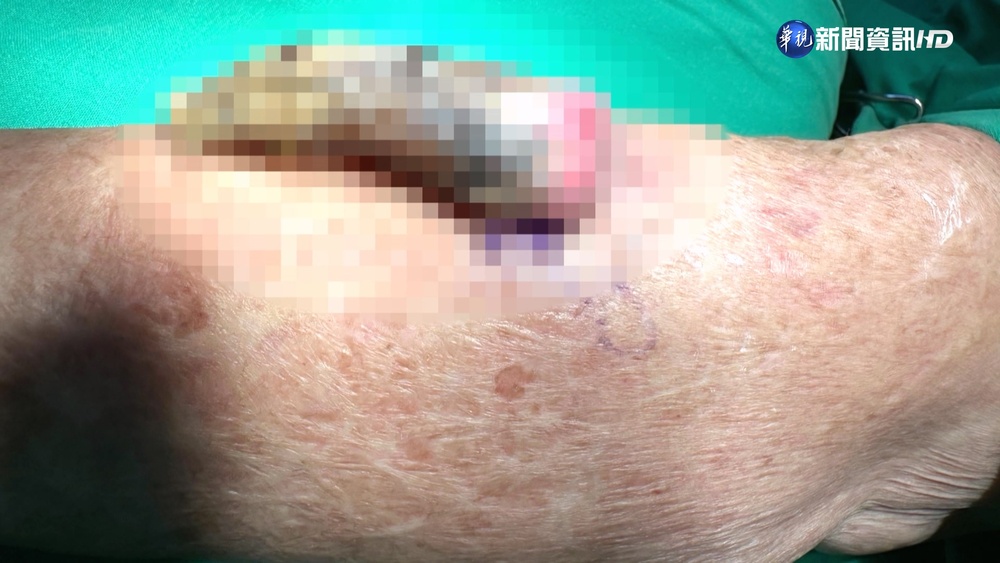 91歲嬤手臂長巨角 "媽祖"開轉診單助求醫