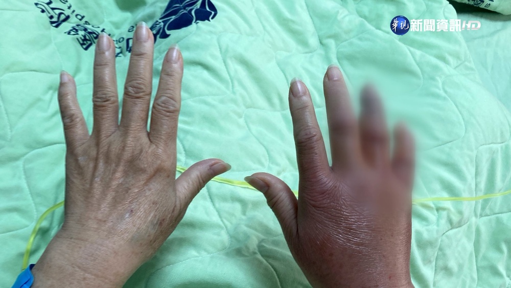 整理海鮮當心! 男被刺傷左臂截肢保命