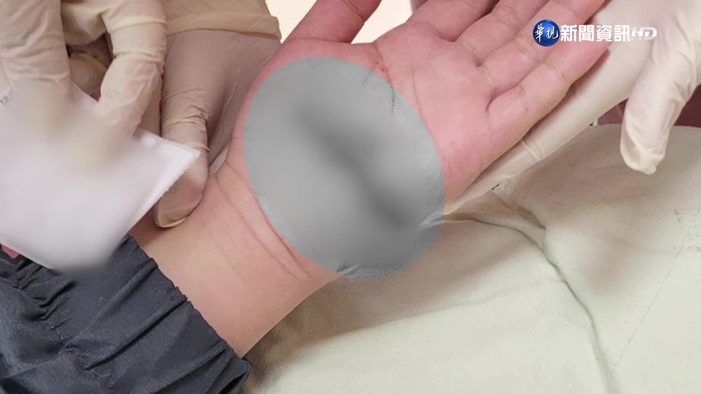 校園扶牆竟遭鐵片割傷! 國一生"慘縫13針"