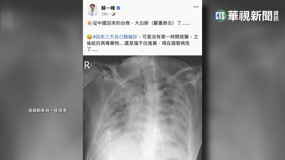 醫曝X光驚見大白肺 60歲台商確診病危插管