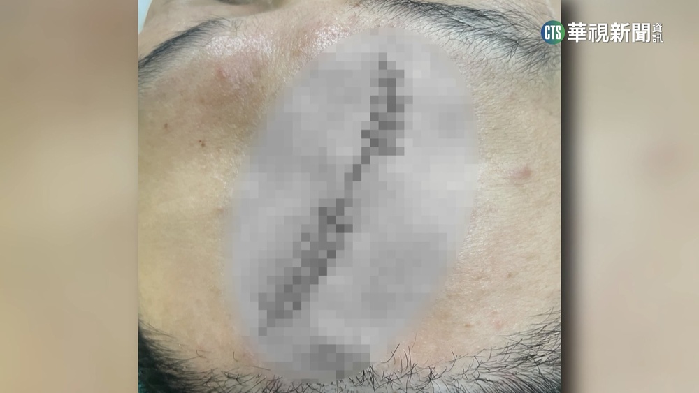 逛年貨大街遭電纜絆倒　父頭部縫10針.兒撞滿頭包