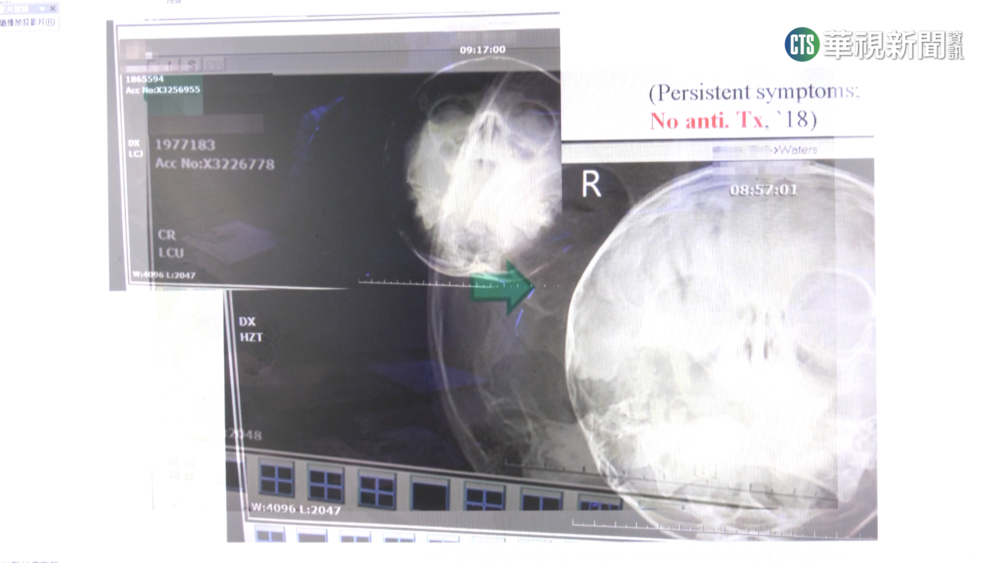 6歲女童罹急性鼻竇炎　醫疑長期戴口罩悶住