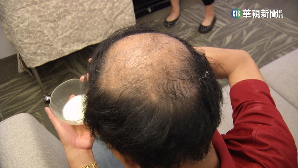 含糖飲料不離身　小心掉髮.心血管問題上門