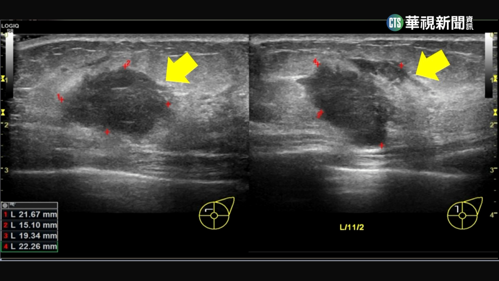 孕期罹「三陰性乳癌」　化療控制順利產健康寶寶