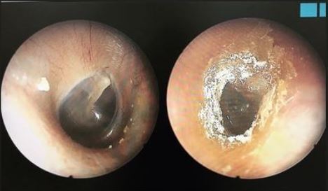 張益豪醫師提到，若耳屎出現白黑相間、棉花樣外觀（右圖），可能是遭黴菌感染，建議就醫接受治療。左圖為正常耳道。（圖翻攝自 張益豪IG）