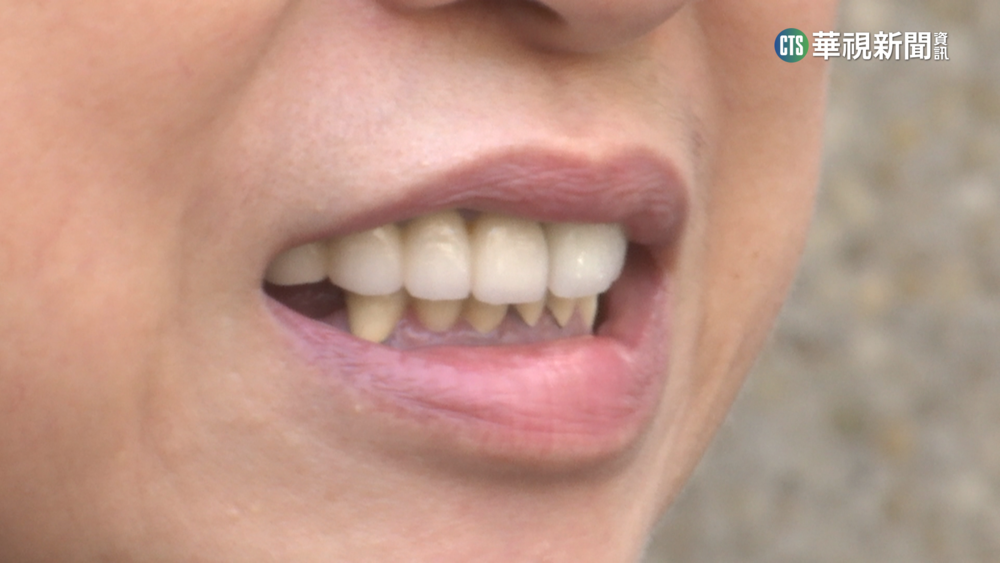 花2萬做陶瓷牙套狀況多！　女控成暴牙.牙縫大