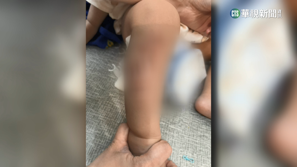 公園轉盤遊具變「烤盤」　1歲女童2度灼傷