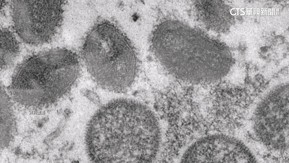 台隔離至結痂全脫落　猴痘患者控：關到崩潰