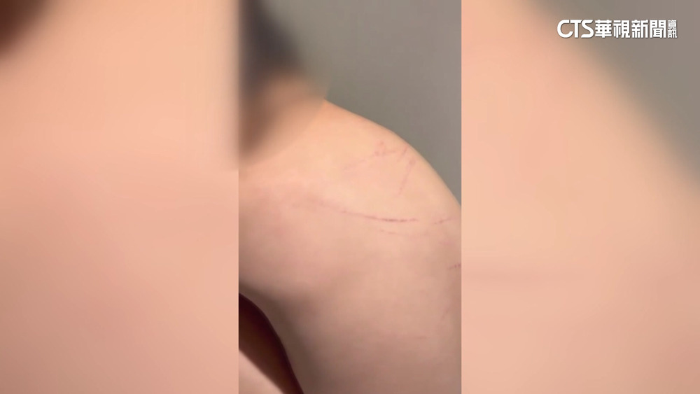 幼兒園不當管教？　3歲童背部受傷　父怒：絕不縱容