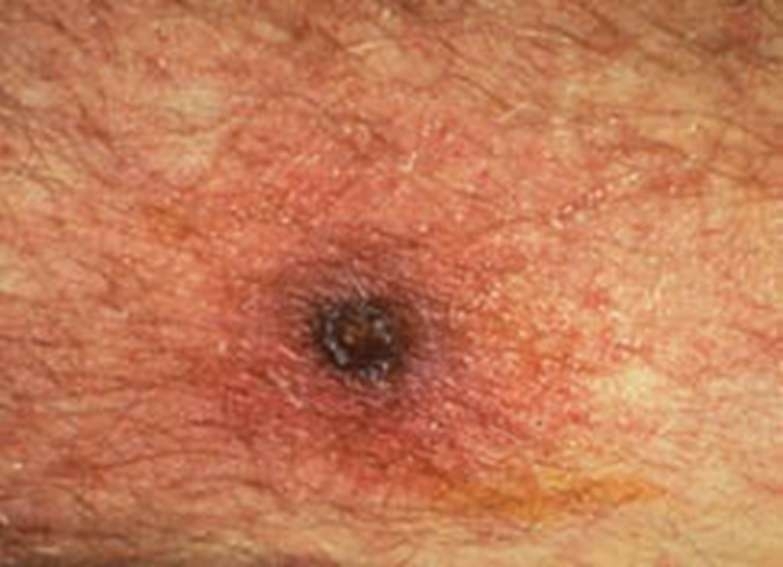遭恙蟎叮咬後皮膚產生之無痛性焦痂。 圖片來源 高雄市立民生醫院 提供