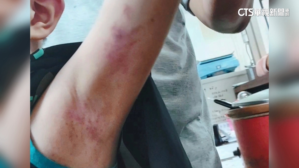 家長控師強拖勒頸　5歲特教兒手臂大片瘀青
