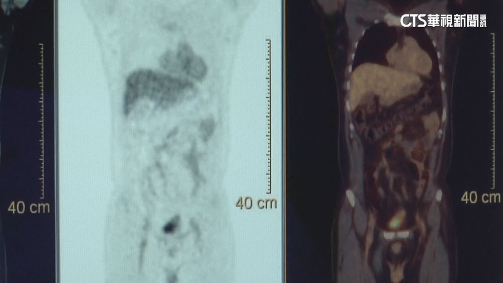 每200人就1人！　「雲嘉南」大腸癌盛行率最高