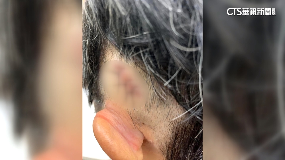 婦上公廁討衛生紙遭清潔員狂毆　滿臉血縫逾20針