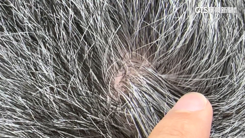 讓「黑色素細胞」再活化？　美科學家拚白髮轉黑