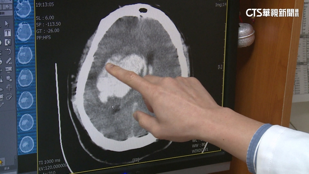 去年47.1萬人中風就醫　50歲以下占1成！