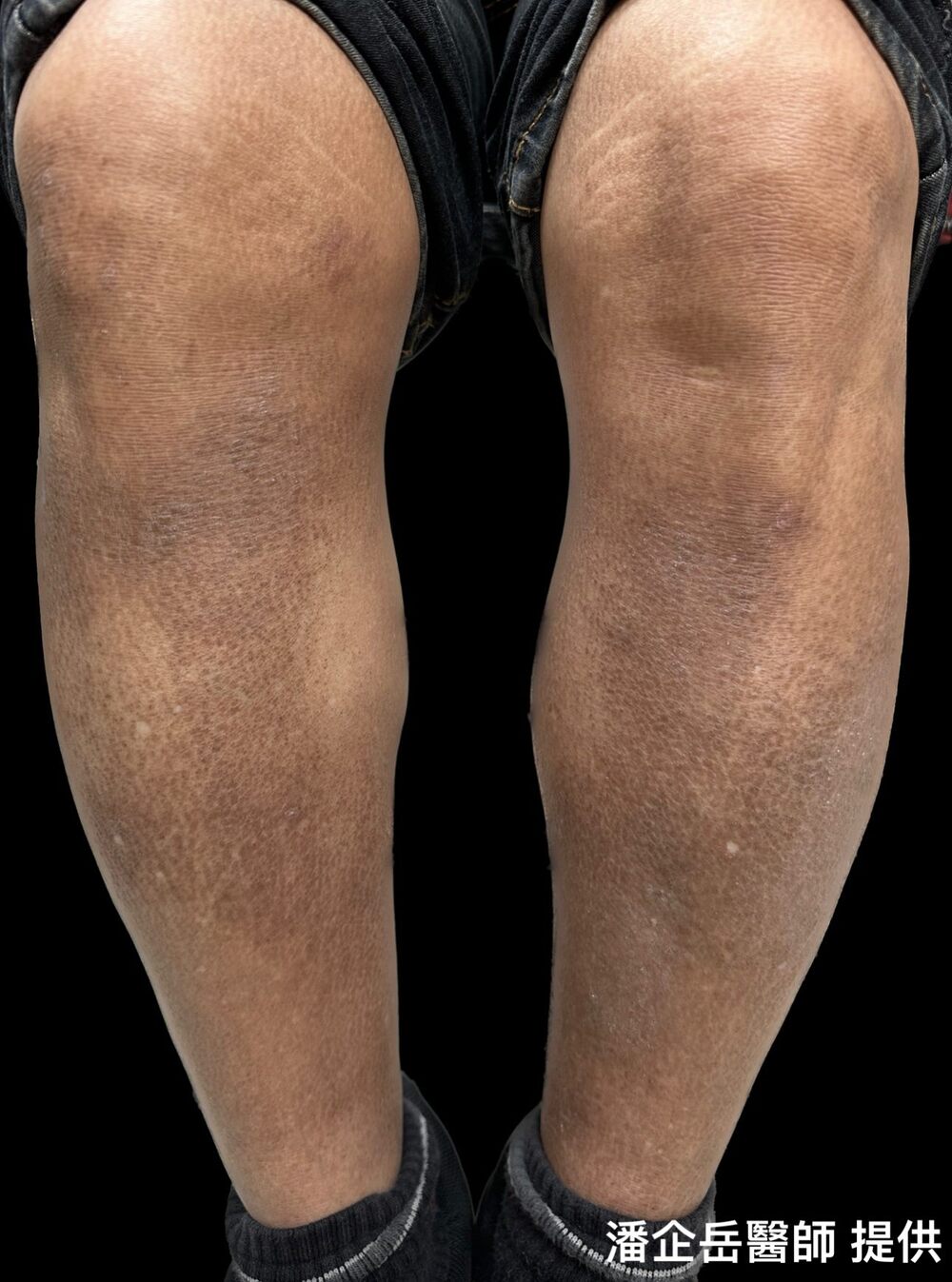 斑塊樣類澱粉沉積症 / 圖片來源 台北市立聯合醫院