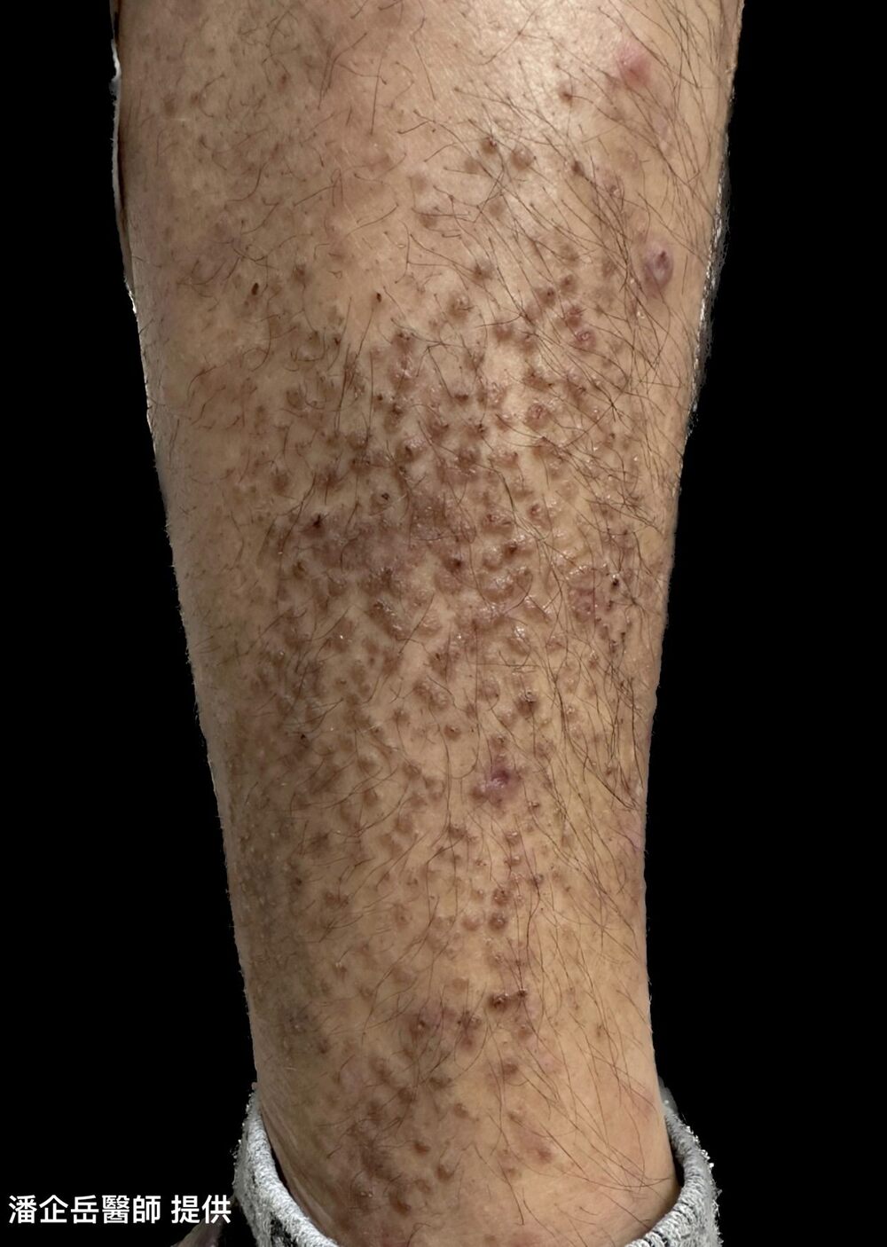 苔蘚及斑塊樣類澱粉沉積症  / 圖片來源 台北市立聯合醫院