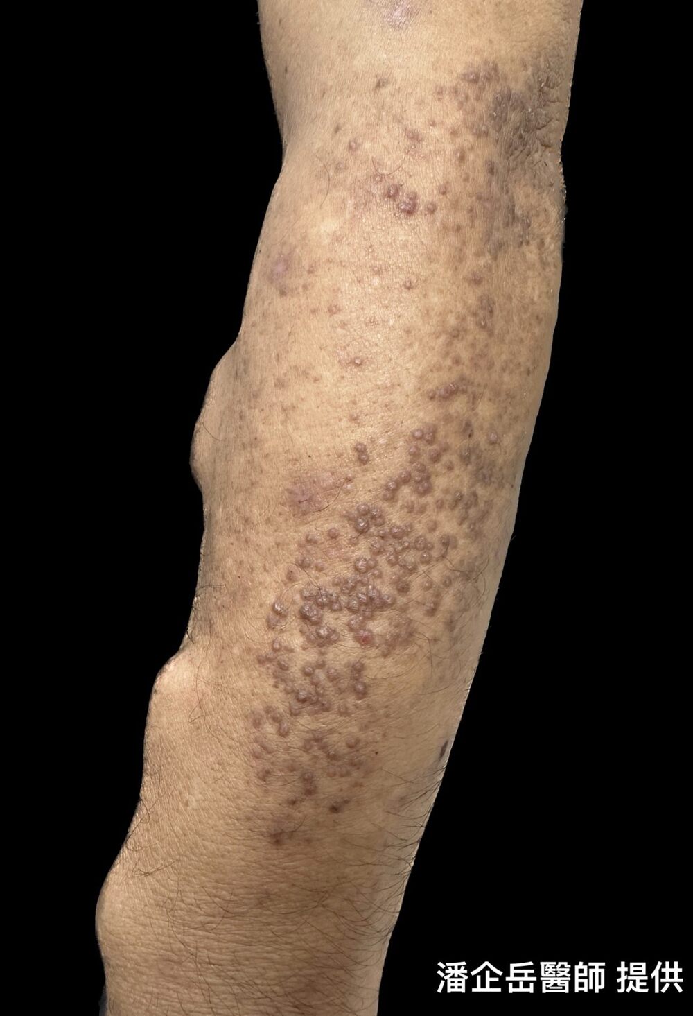 苔蘚樣類澱粉沉積症 / 圖片來源 台北市立聯合醫院