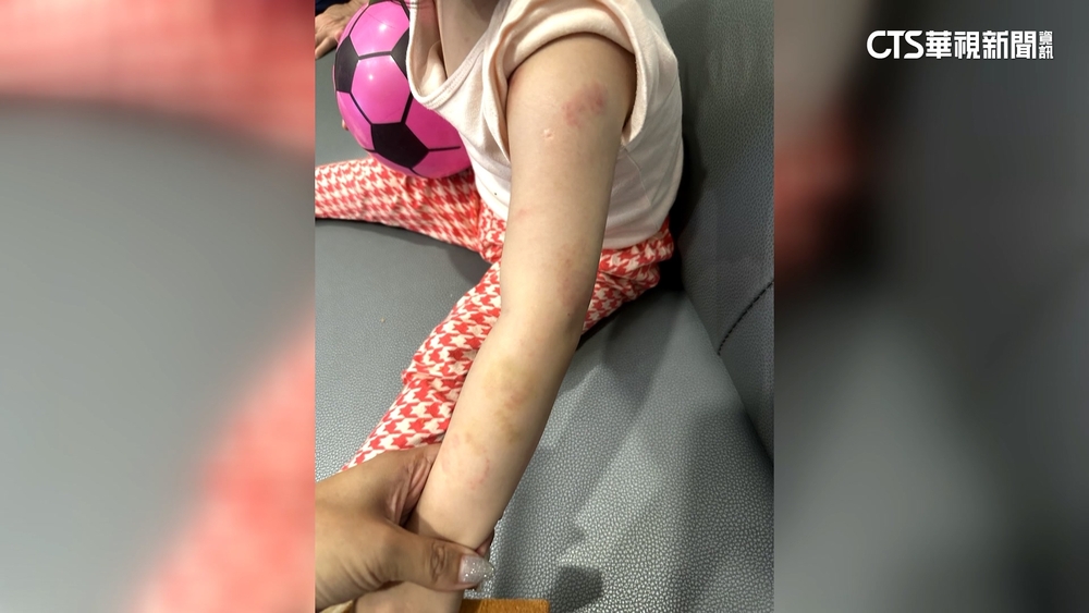 幼童打鬧咬傷女兒　家長控幼兒園老師漠視