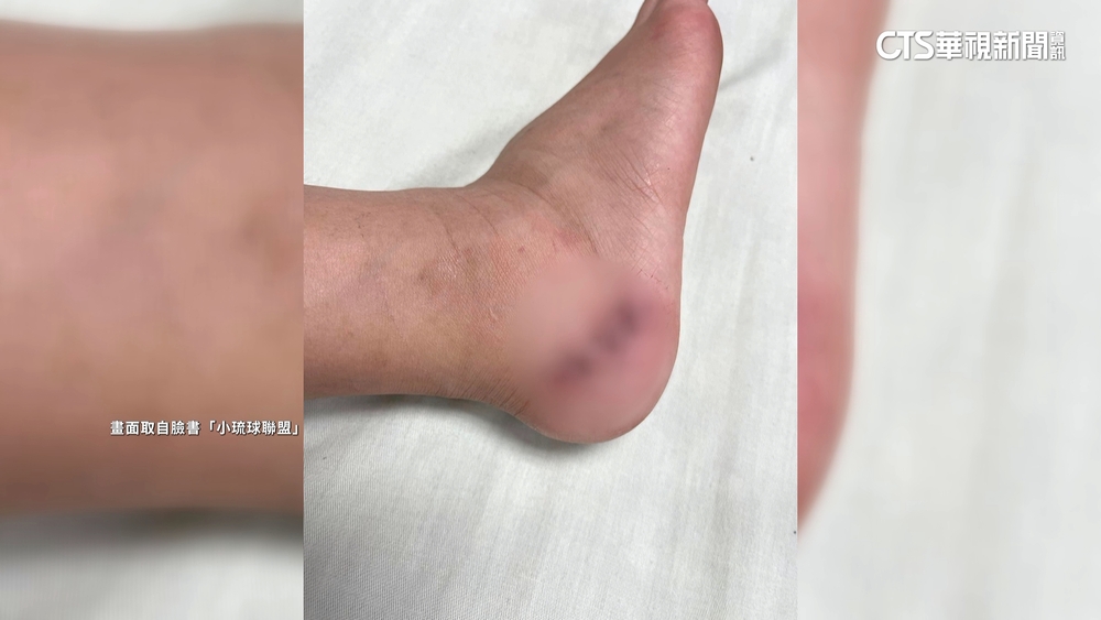 小琉球潮間帶割傷腳遊客索賠　民宿：只負責代訂