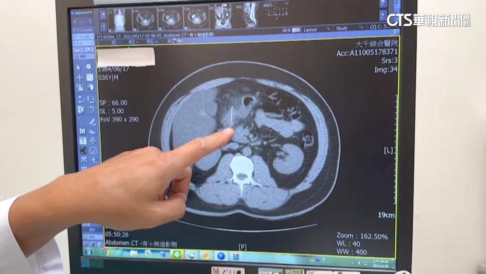 4公分魚刺「卡十二指腸」　男腹膜炎險敗血性休克