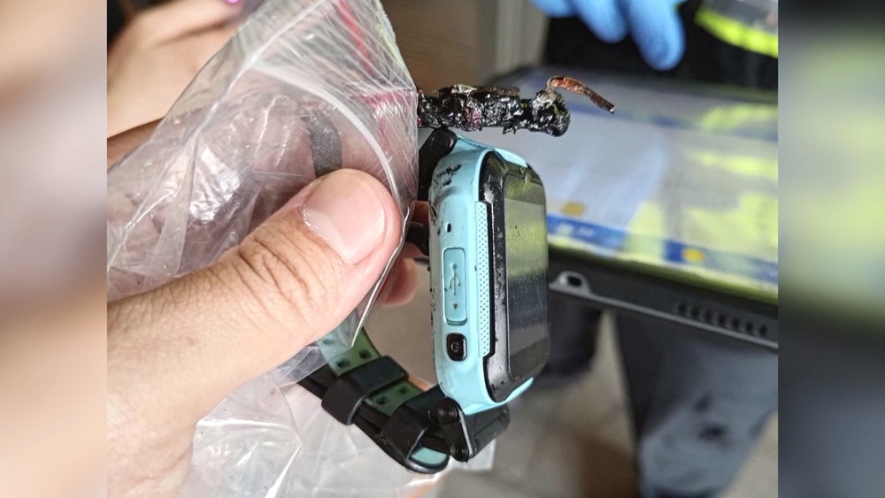 Herowatch智慧錶突爆炸！　童二度燒燙傷恐需植皮