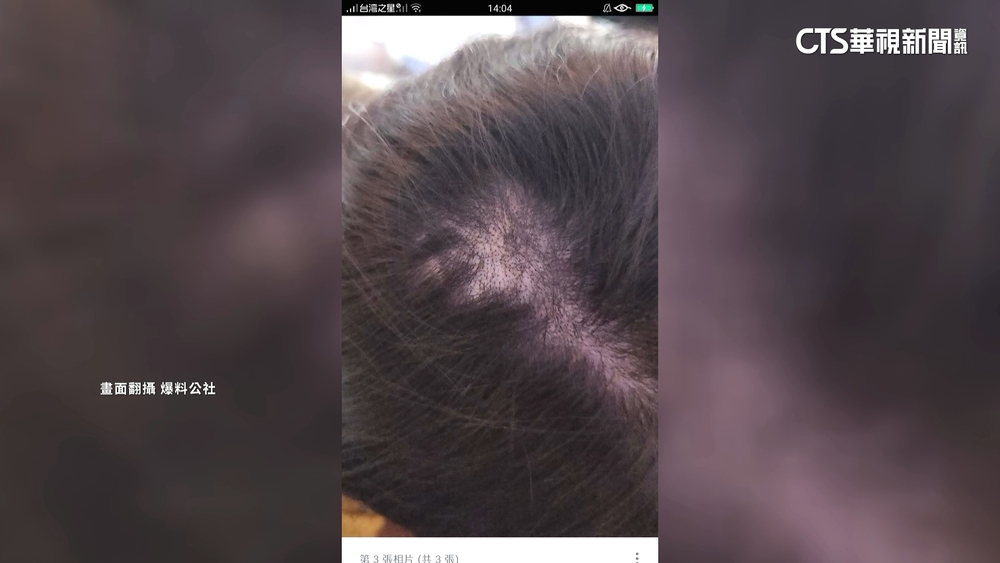 女染髮後頭皮異常腫痛　「狂落髮」韓國行慘毀