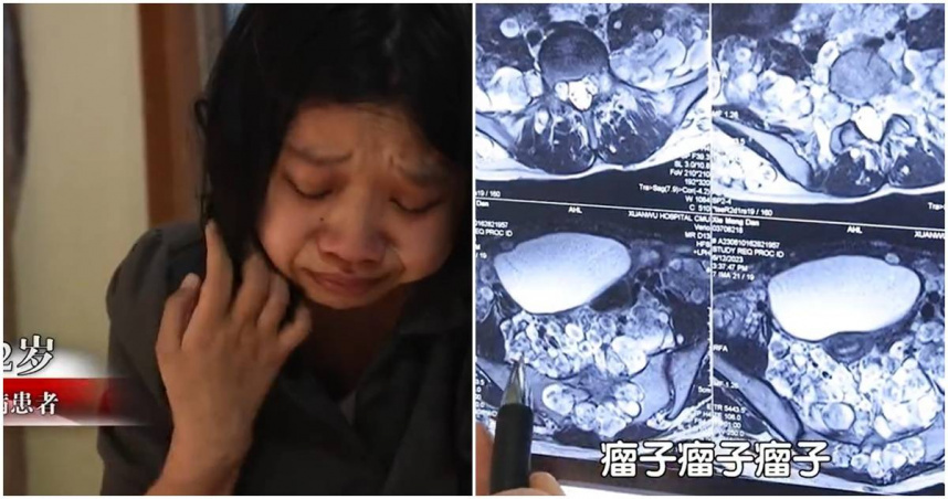 22歲女體內長滿「上千顆腫瘤」　醫師曝：不治療恐在痛苦中死去