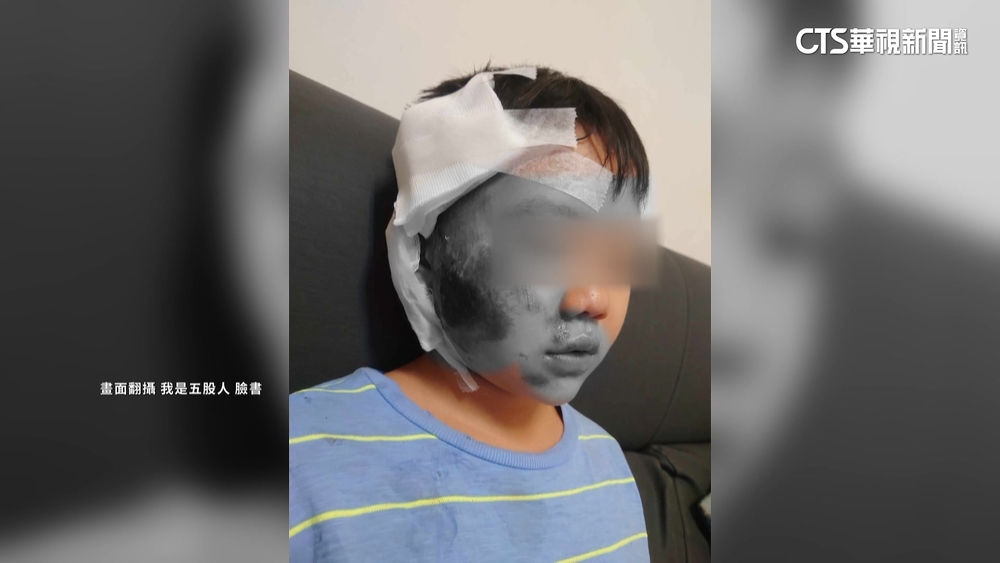 新北10歲童走斑馬線被機車撞倒　臉部嚴重擦傷