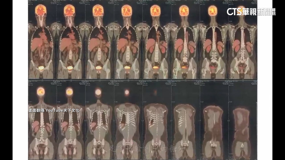 體內近距消滅癌細胞　標靶放療由內而外「毒殺」腫瘤