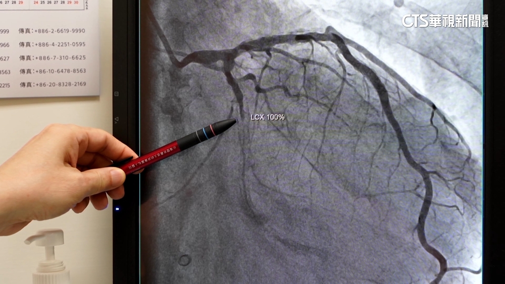 67歲男12年6次急性心肌梗塞　爆2大壞習慣