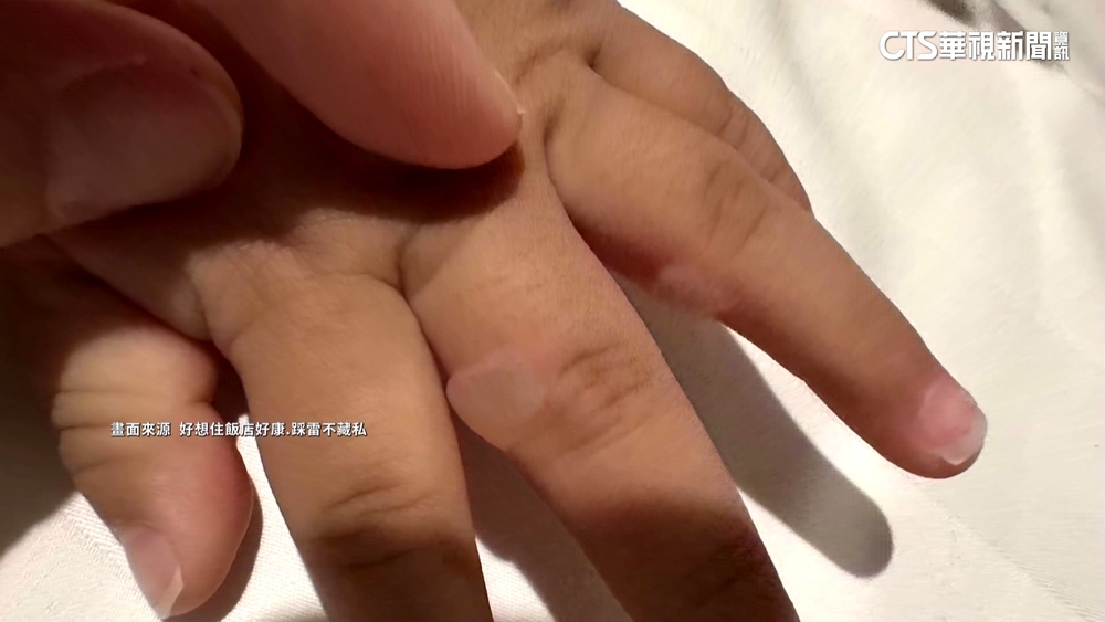 浴室蒸氣孔燙傷2歲童手指　飯店：願賠醫藥費