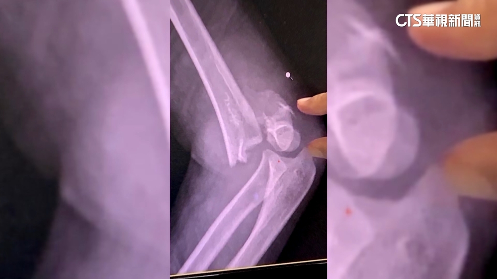 童拉環跌落斷手　家長控溫泉山莊管理不善